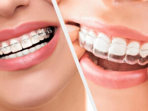 Orthodontie et alignement dentaire